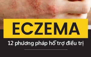 Không cần thuốc, hãy giảm eczema theo 12 cách này