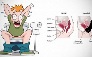 Điều gì xảy ra khi bạn nhịn đại tiện?