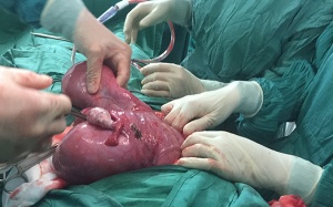 Người phụ nữ phải cắt toàn bộ tử cung vì mang khối u “khủng” nặng 8 kg