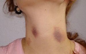 Nốt xuất huyết dưới da có nguy hiểm không?