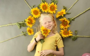 8 sự thật có thể bạn chưa biết về bệnh bạch tạng