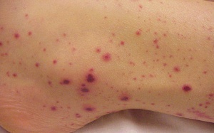 Những yếu tố nguy cơ gây xuất huyết giảm tiểu cầu