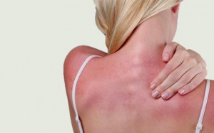 Hạ chí đã tới: Cần đề phòng ngộ độc nắng