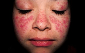 Mắc lupus ban đỏ có nên ăn thịt chim bồ câu?