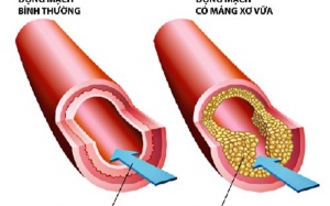 3 loại acid amin giúp làm sạch động mạch, giảm xơ vữa động mạch