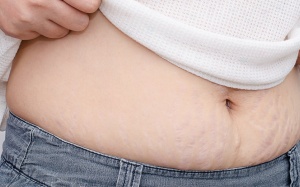 5 cách giúp bạn làm mờ vết rạn da ngay tại nhà