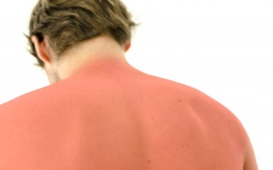 Bổ sung vitamin D có thể giúp cải thiện tình trạng cháy nắng