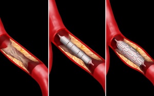 Các biến chứng thường gặp sau khi đặt stent mạch vành
