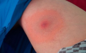 4 biện pháp tự nhiên giúp phòng tránh và điều trị bệnh Lyme hiệu quả
