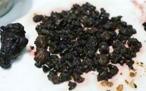 Bỏ ăn sáng 8 năm, người phụ nữ có hơn 200 viên sỏi mật trong bụng