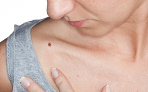 Mối liên hệ giữa bệnh Parkinson và bệnh ung thư da