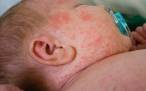 Tại sao lượng tiểu cầu vẫn thấp sau khi khỏi sốt xuất huyết?