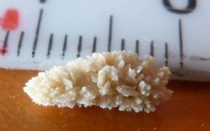 Vì sao mùa Hè làm tăng nguy cơ bị sỏi thận?