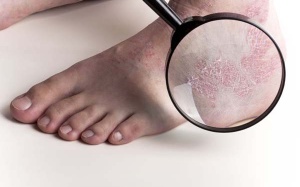 8 cách đơn giản để giảm bệnh vảy nến