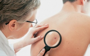 Nốt ruồi thay đổi màu sắc và kích thước có nguy hiểm?