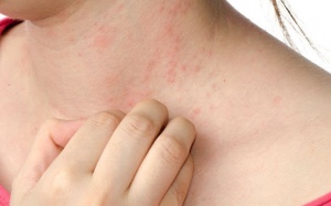 Nên làm gì khi bị viêm da cơ địa để bệnh không nặng lên?