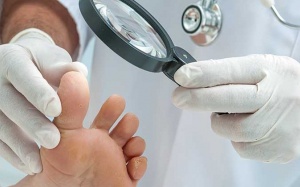 Cách trị nấm móng chân hiệu quả ngay tại nhà