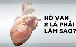 Làm sao chung sống với tình trạng hở van 2 lá?