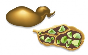 Liệu bạn có nguy cơ cao bị sỏi mật?