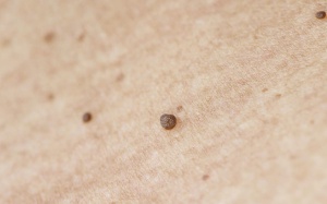 Cách trị mụn thịt ở cổ tại nhà với giấm và tinh dầu