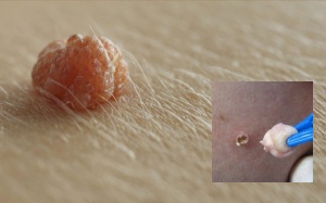 Trị mụn thịt ở cổ bằng... kéo, băng dính, chỉ nha khoa và sơn móng