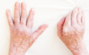 5 điều cần biết về bệnh tự miễn