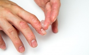 Người bị viêm khớp vảy nến nên uống thuốc gì để giảm bệnh?