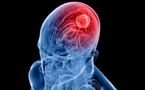 Virus Zika có thể được sử dụng để điều trị ung thư não