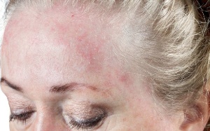 5 yếu tố làm tăng nguy cơ mắc bệnh tự miễn 