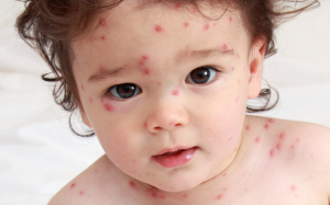 Em bé bị thủy đậu, bố mẹ phải làm gì?