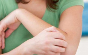 Nổi mề đay khi điều trị tuyến giáp có nên dùng TPCN Ích Giáp Vương?