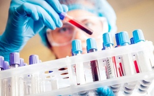 Xét nghiệm kiểm tra cholesterol, những điều bạn cần biết