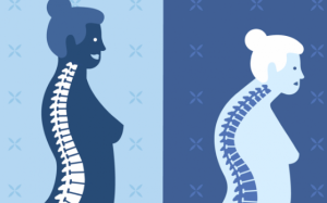 Bạn bị loãng xương: Áp dụng ngay 5 cách này!