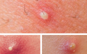 Mọc nhiều mụn nhọt ở đùi và mông là bị làm sao?