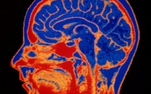 Chóng mặt, ngứa ran vùng đầu có phải dấu hiệu đột quỵ?