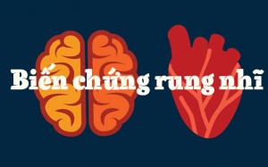 Người bệnh rung nhĩ cẩn thận với 2 biến chứng có thể gây tử vong