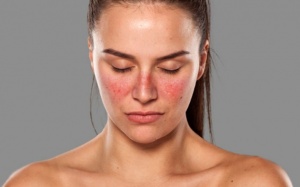 Bổ sung probiotics có thể giúp giảm viêm thận lupus