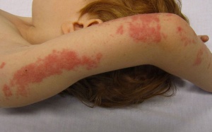 Dùng Subạc có làm lành vết loét ngoài da do zona thần kinh?