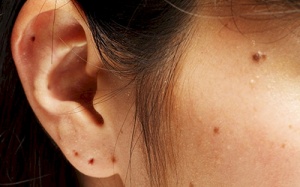 Mọc nốt ruồi có lông ở dưới cánh mũi, có tẩy được không?