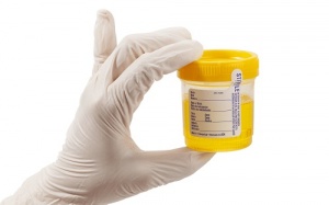 Vai trò của xét nghiệm nước tiểu với bệnh đái tháo đường