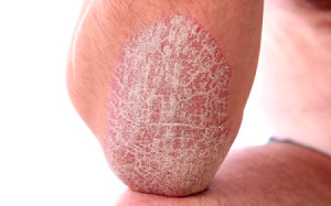 Bị bệnh vẩy nến: Nhớ dùng nước cốt dừa