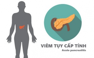 Đau bụng trên có thể là triệu chứng viêm tụy cấp tính