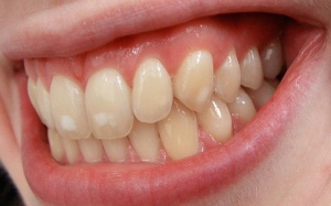 10 cách tự nhiên loại bỏ đốm trắng xấu xí trên răng