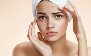 Whey protein có thể gây ra mụn, đặc biệt ở phụ nữ