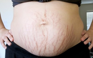 Da chảy xệ và bị rạn sau sinh, có cách nào khắc phục không?