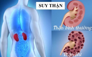 Làm thế nào để giảm thiểu các biến chứng khi mắc suy thận độ 3?