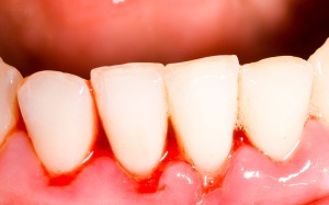 Biện pháp tự nhiên khắc phục chảy máu chân răng