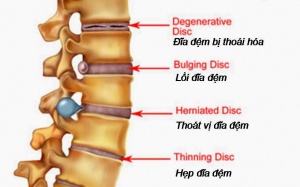 Bị thoát vị địa đệm cần ăn uống và tập luyện thế nào để điều trị bệnh?