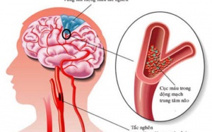 Bị tai biến, liệt nửa người cần có chế độ dinh dưỡng thế nào để phục hồi tốt?