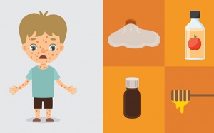 9 biện pháp giúp hỗ trợ điều trị bệnh thủy đậu tại nhà